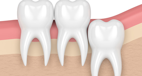 Understanding Wisdom Tooth Removal